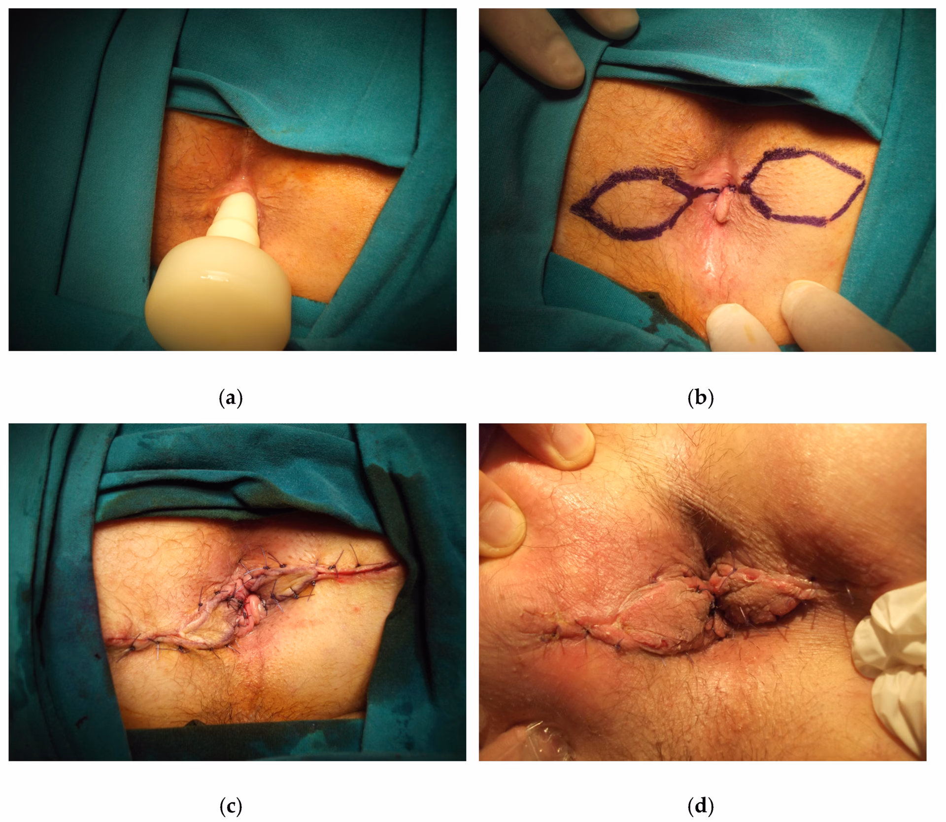 What are hemorrhoids?