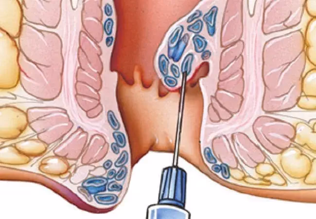 What is a hemorrhoidectomy?