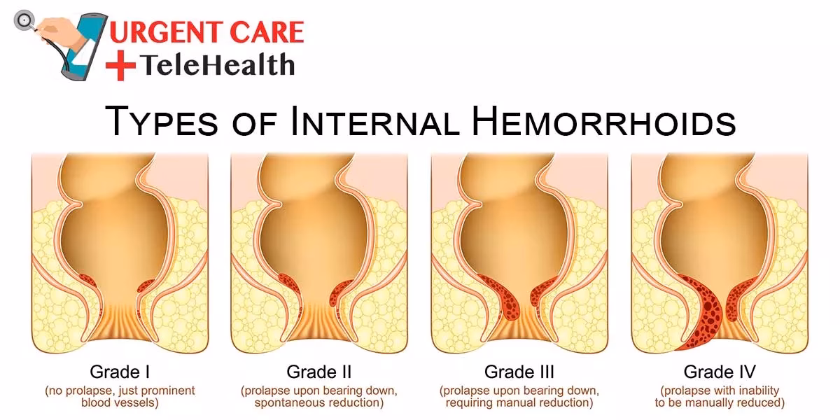 Should you seek medical care for hemorrhoids?