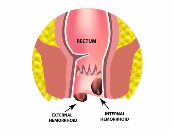 Can hemorrhoids and polyps cause a lump in the rectum?