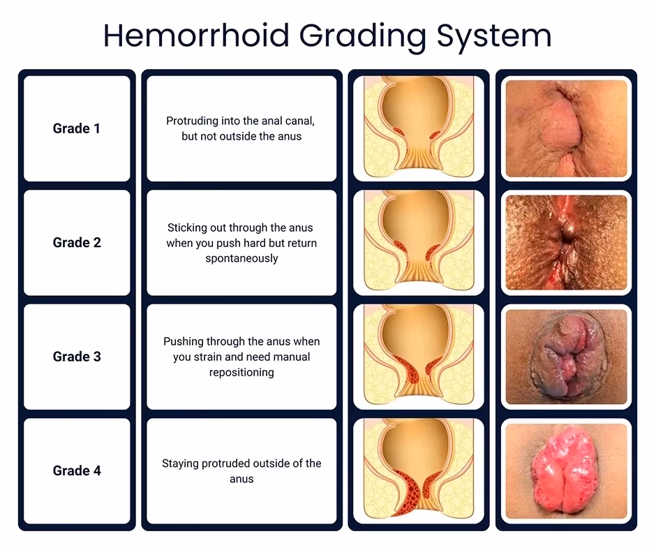 Do hemorrhoids leak fluid?