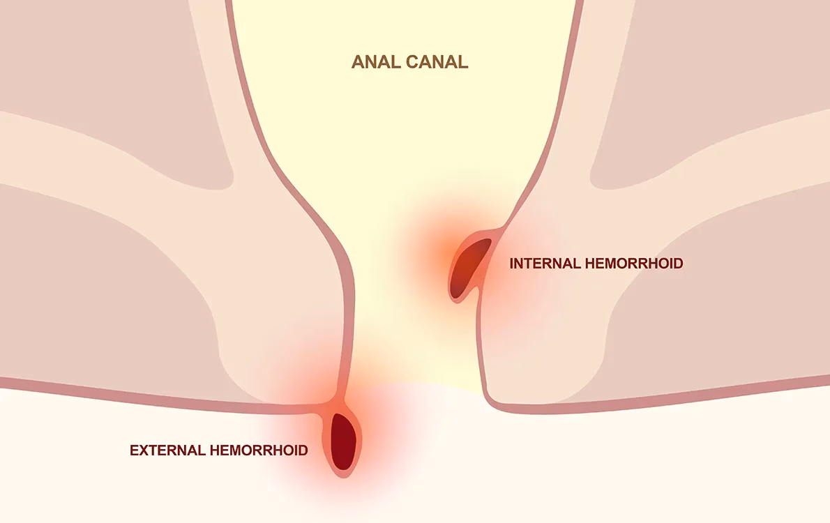 What are hemorrhoids and why are they important?
