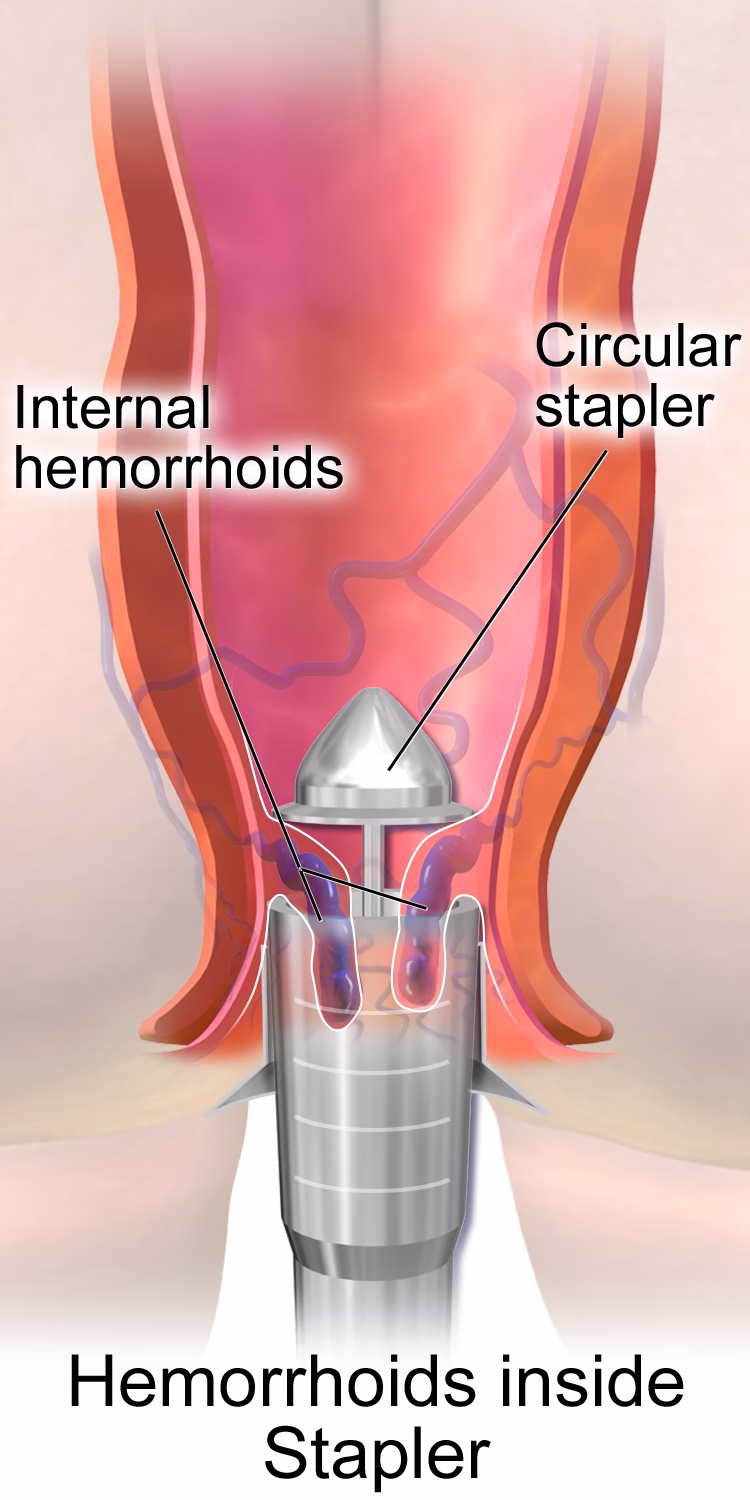 What is hemorrhoid surgery?