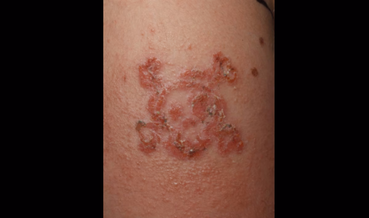 Can henna cause contact dermatitis?