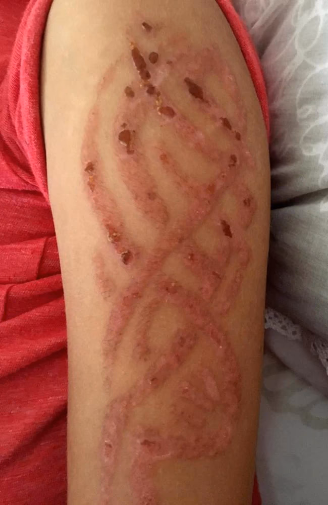 Do black henna tattoos cause allergic dermatitis?