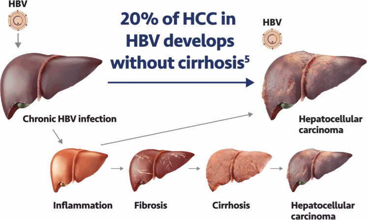 What is the end stage of chronic liver disease?