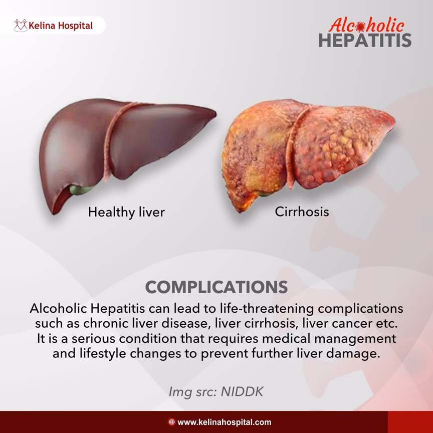 What are the symptoms of alcoholic hepatitis?