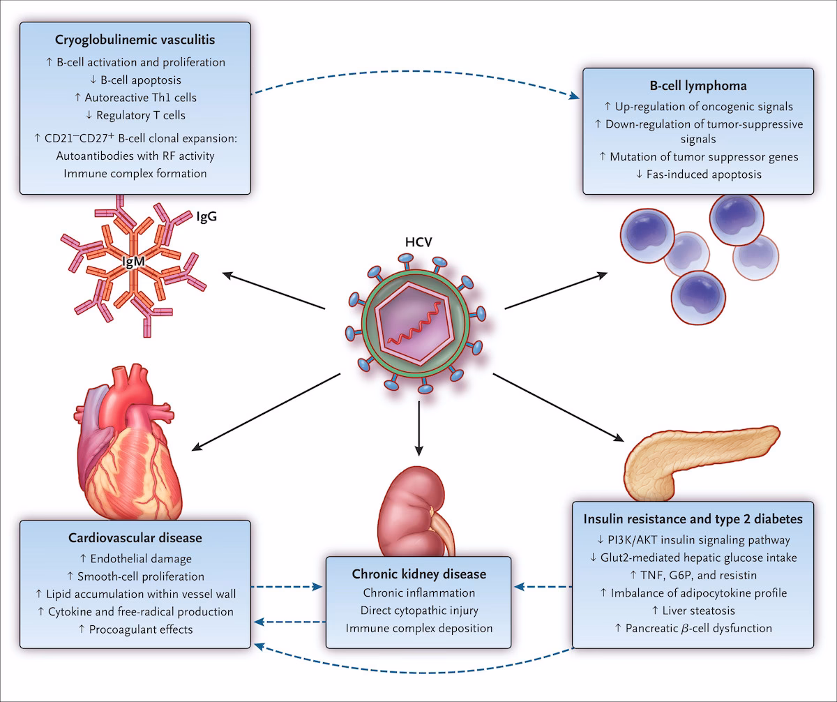 What is hepatic lymphoma?