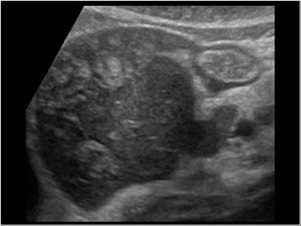 How does acute hepatitis affect ultrasound findings?