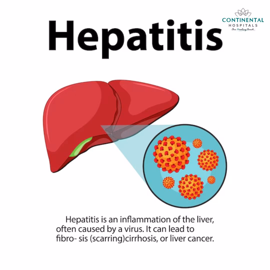 What is viral hepatitis E?