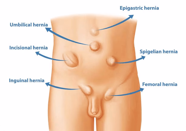Is hernia surgery covered under insurance in Chennai?