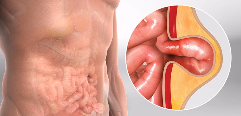 How much does an inguinal hernia cost?