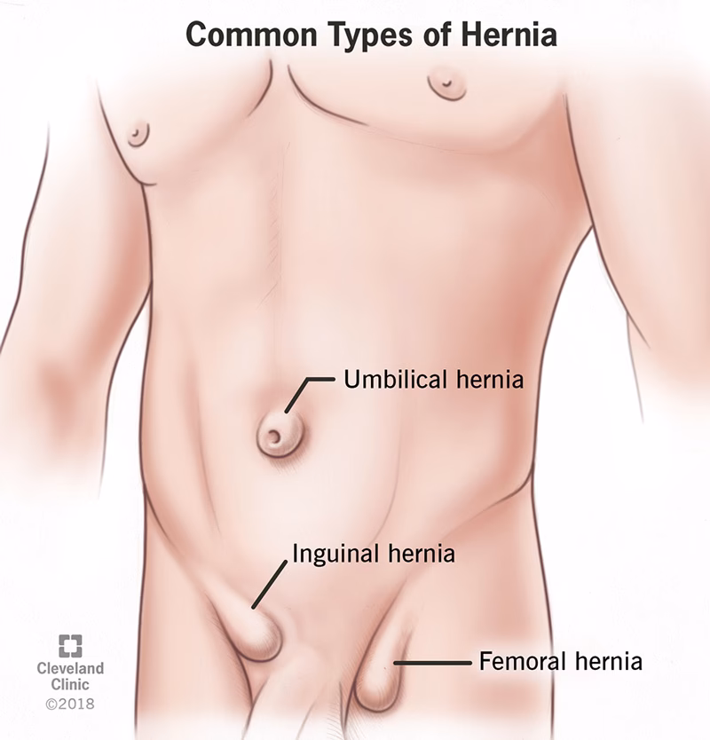 What happens if you have a hernia after surgery?