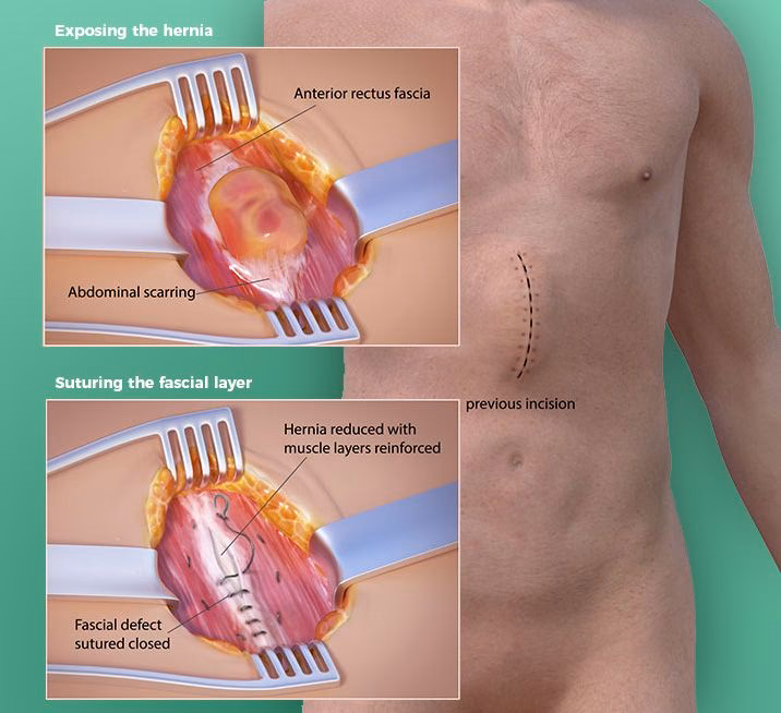 What is open hernia repair?