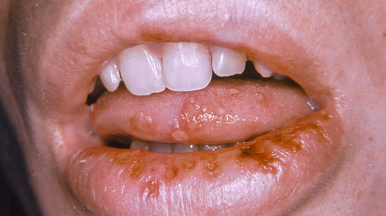 Can HSV2 be transmitted orally?