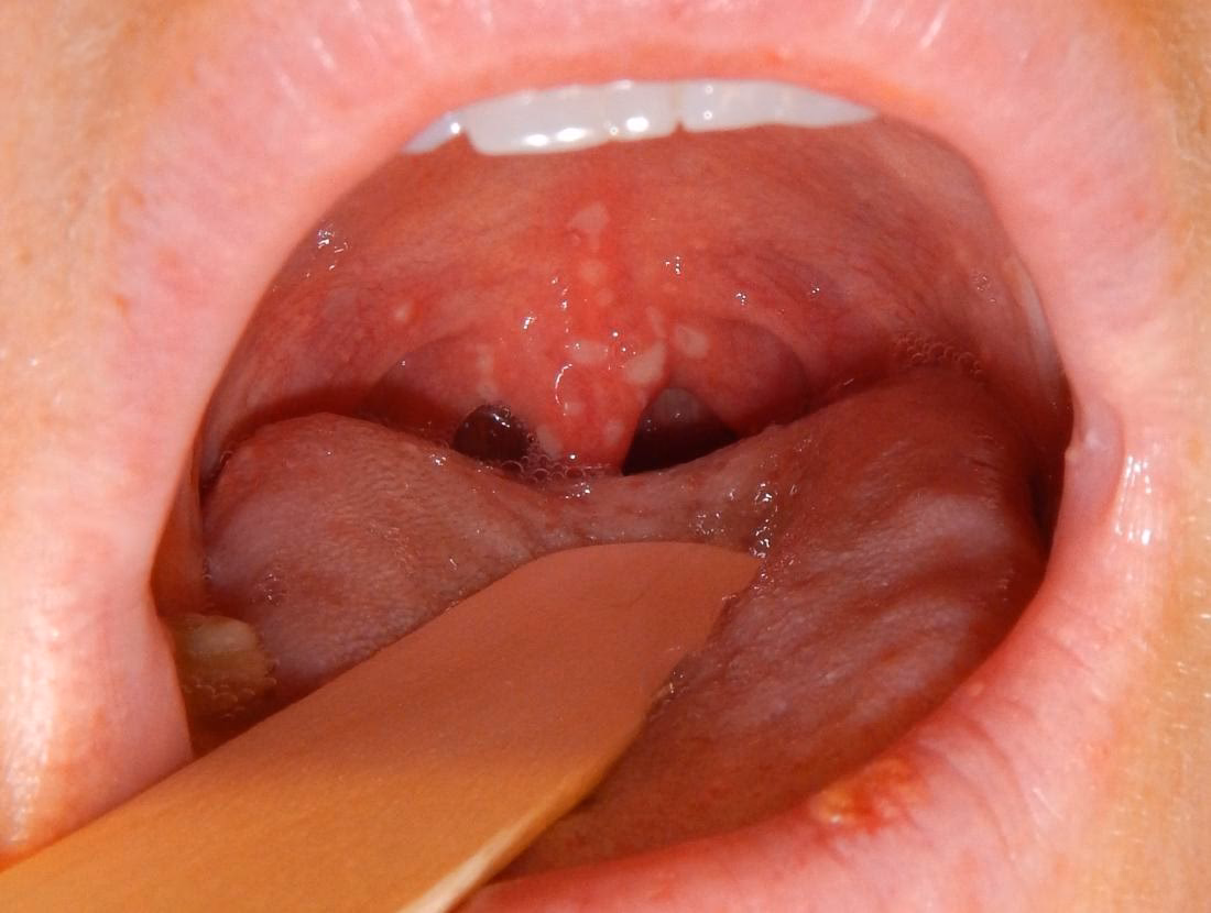 What is herpes in the throat?