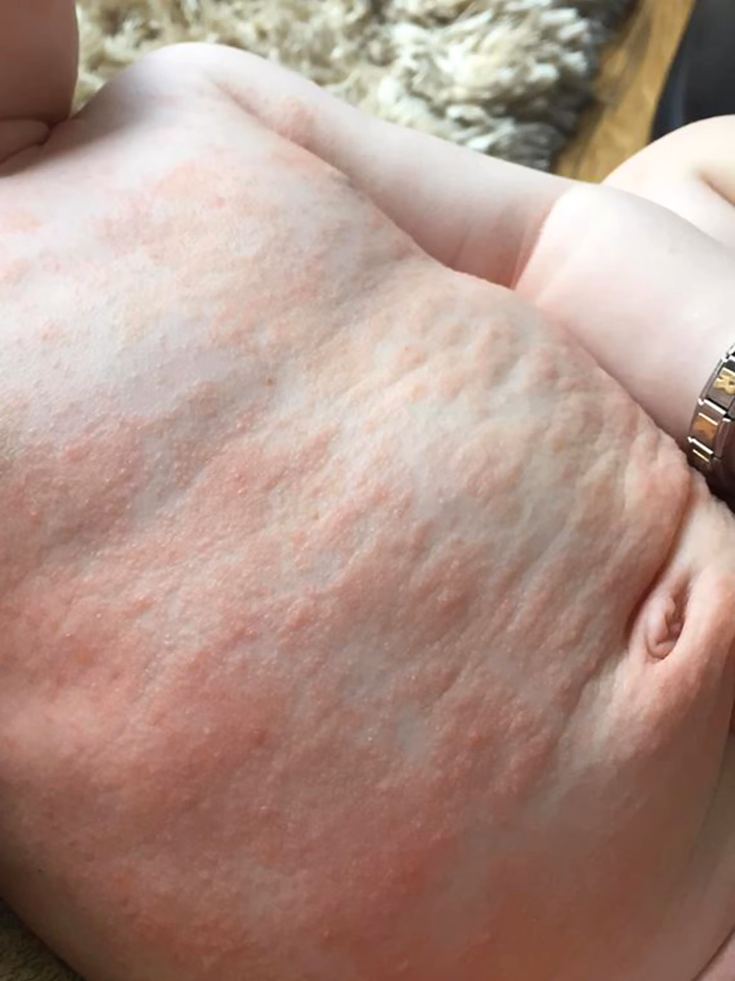 Can you have a baby with genital herpes?