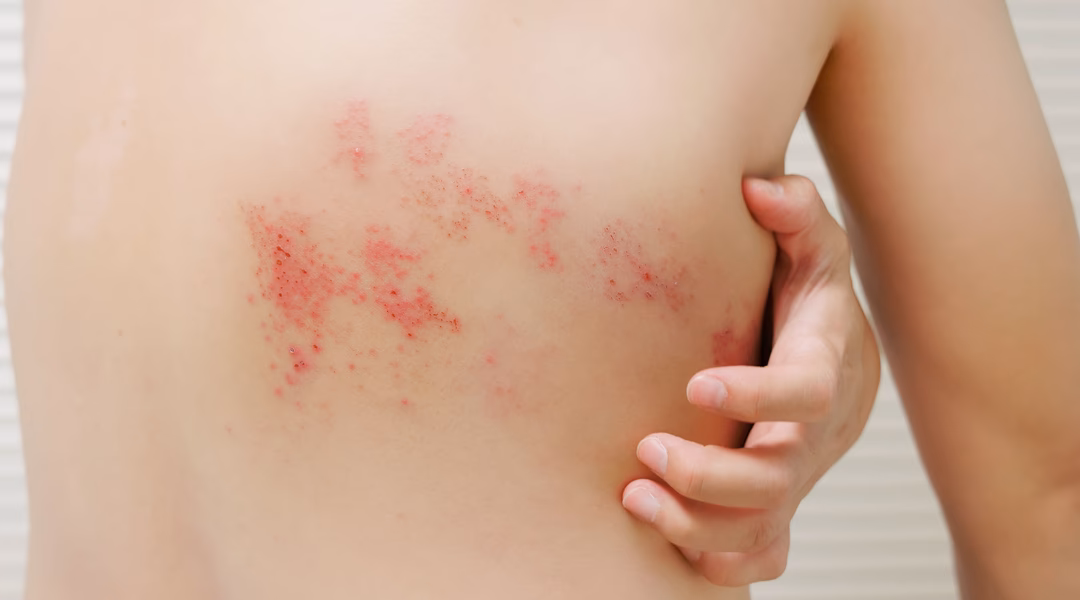 ¿Cómo se transmite el herpesvirus humano 6?