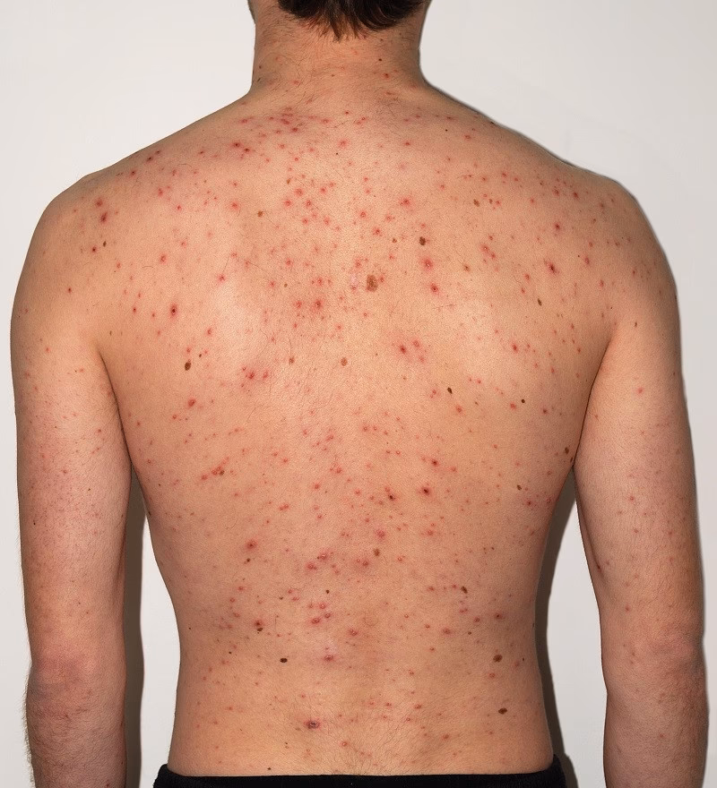 ¿Qué es el herpesvirus humano tipo 8?