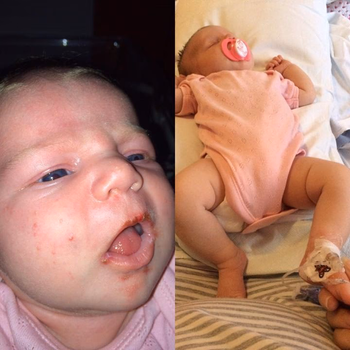 How does neonatal herpes affect newborn babies?