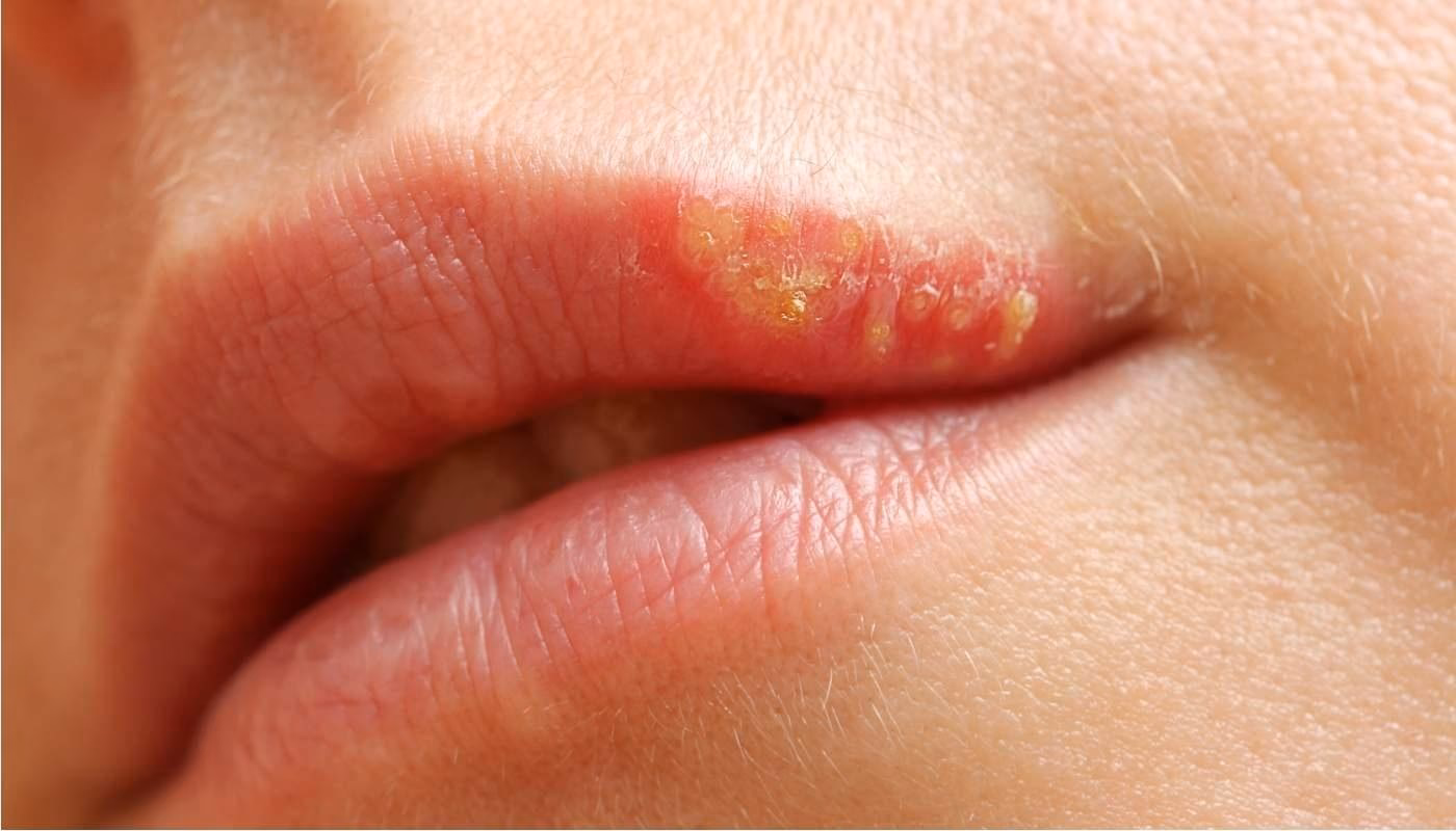 Como evitar a infecção do herpes simples na região genital?