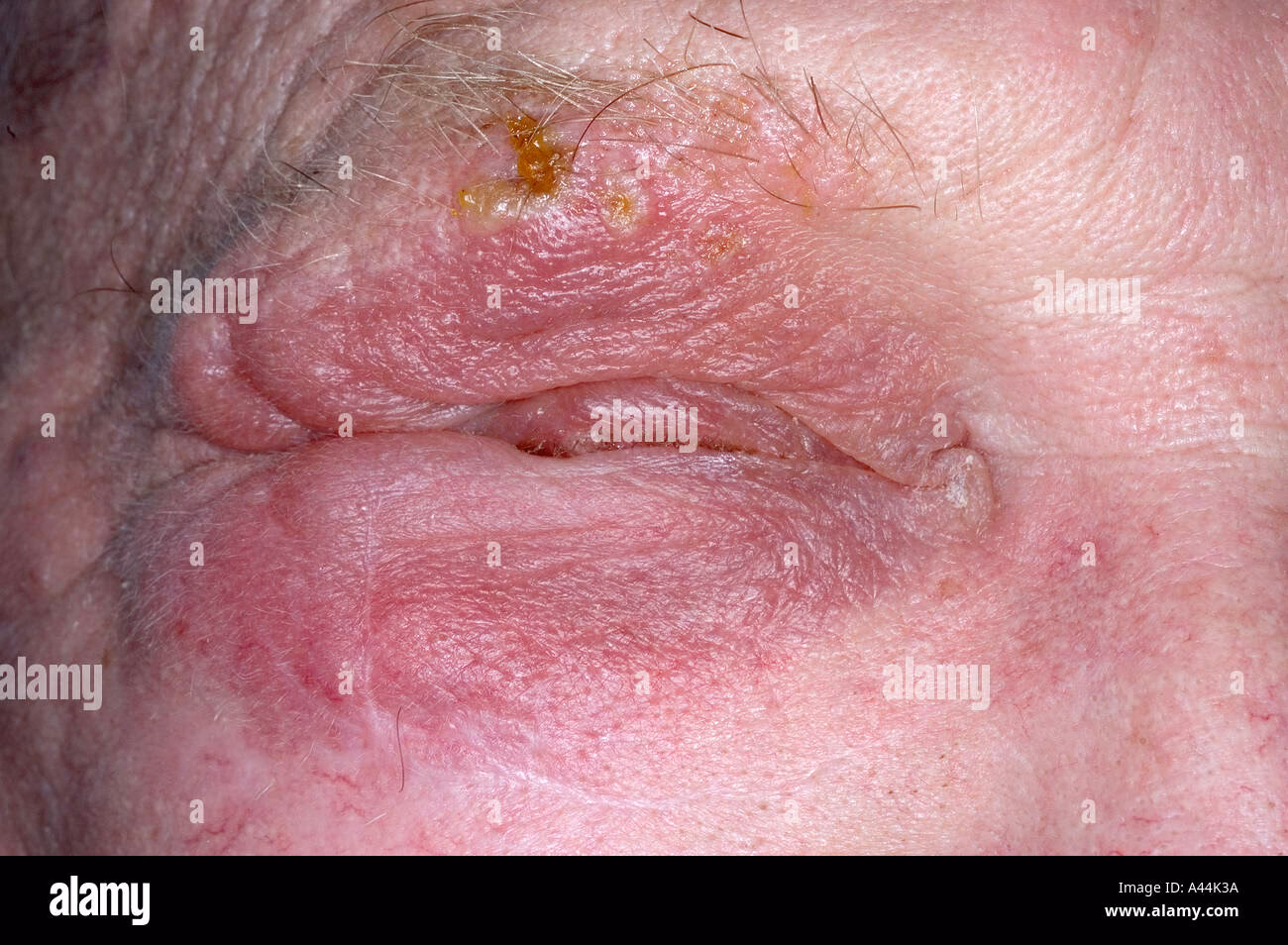 Was tun bei einem herpesausschlag im Gesicht?