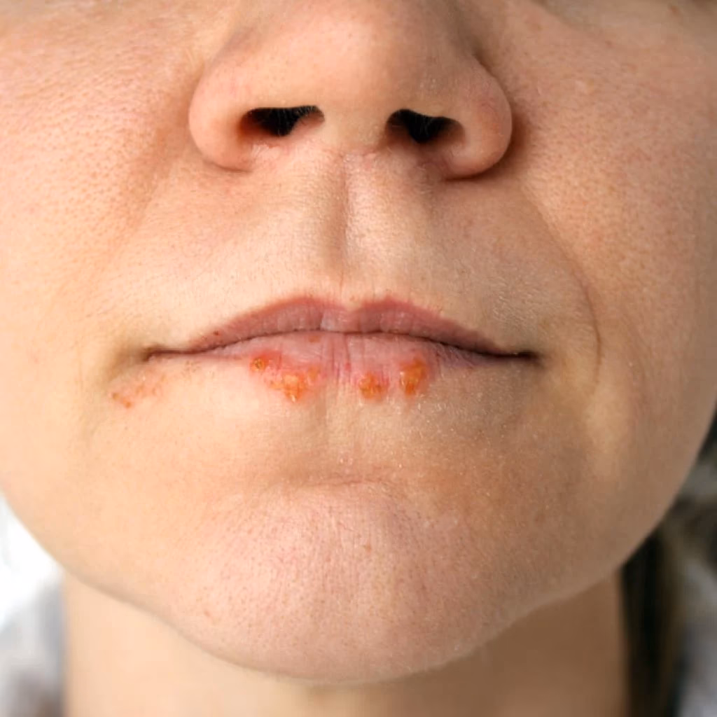 Can stress reactivate the herpes simplex virus?