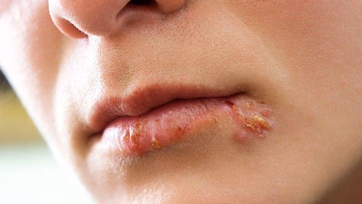 What causes oral herpes?