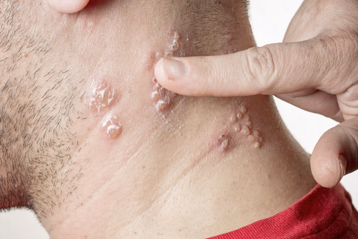 Kan man have herpes ved kønsdelene?