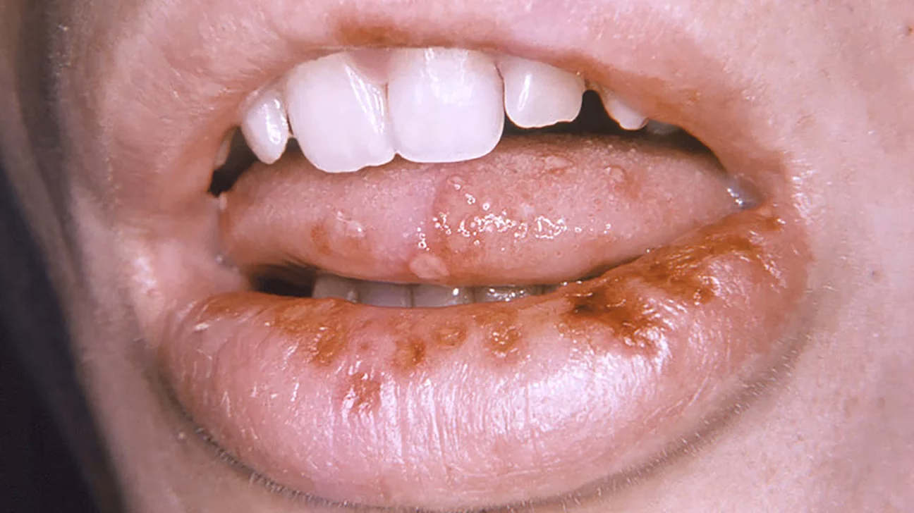¿Dónde suelen aparecer las ampollas del herpes bucal?