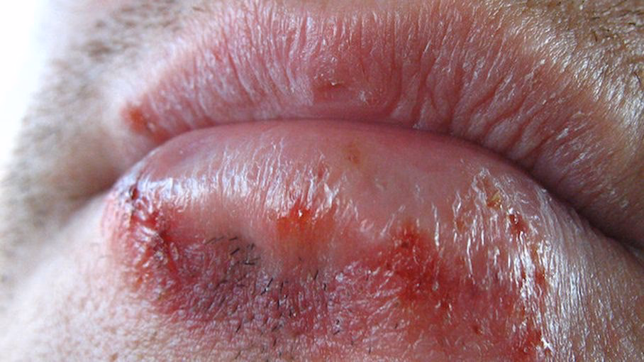 Combien de temps dure l’herpès ?