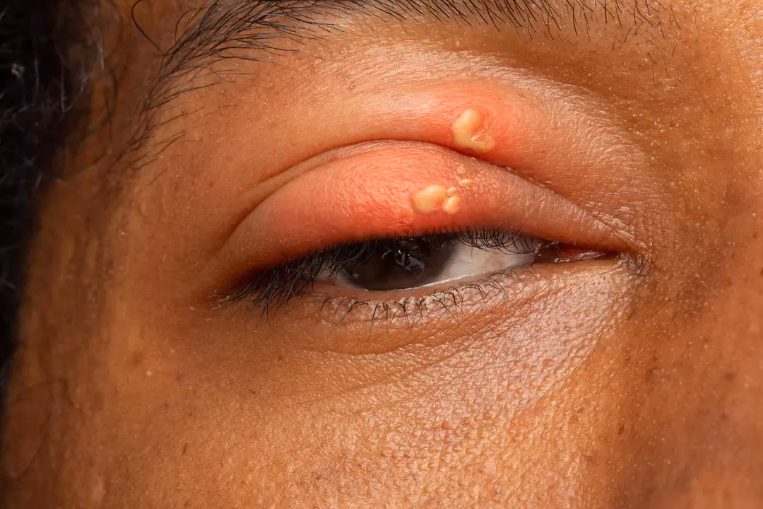 Quels sont les symptômes de l’herpès ?