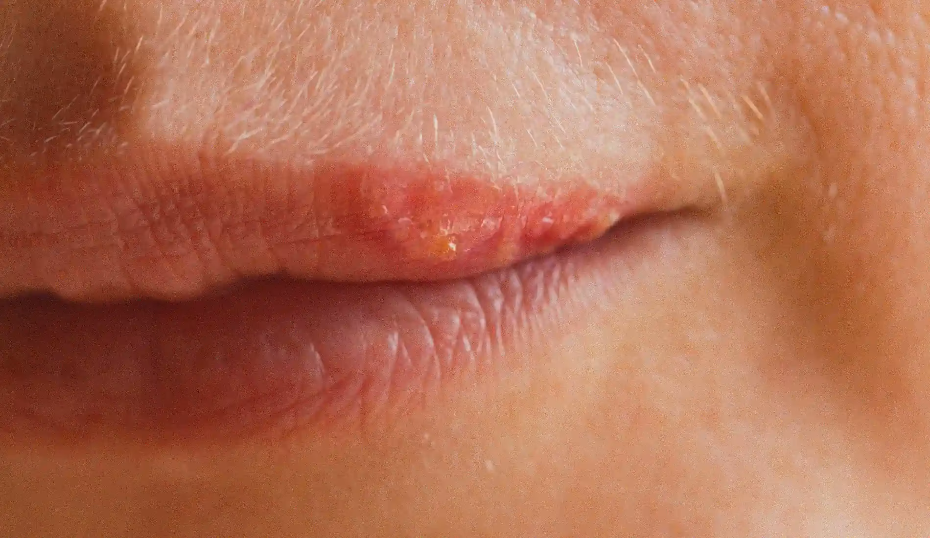 Comment se transmet l’herpès génital ?