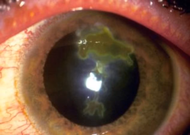 Can a herpes virus affect the eye?