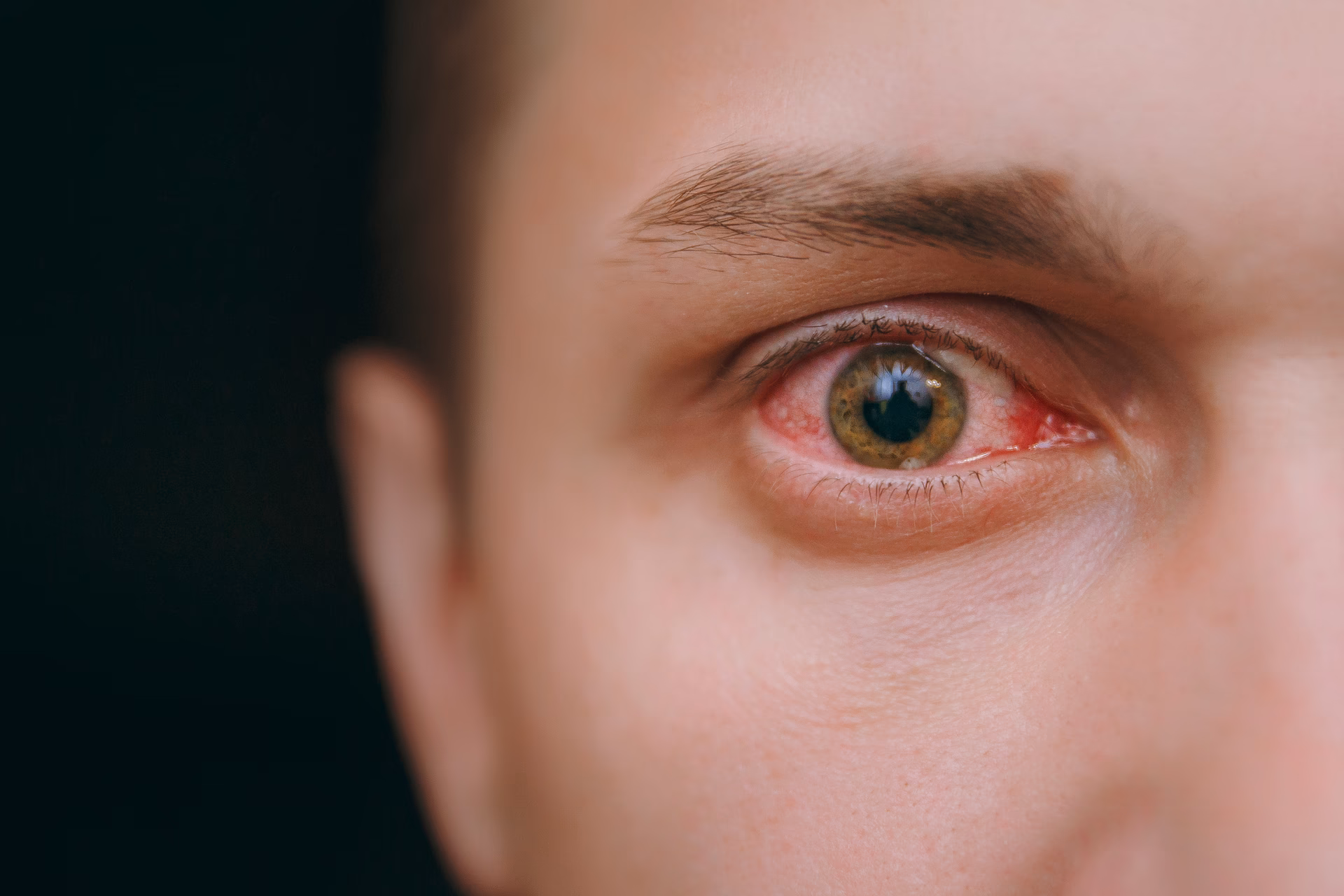 Can a herpes virus affect the eye?