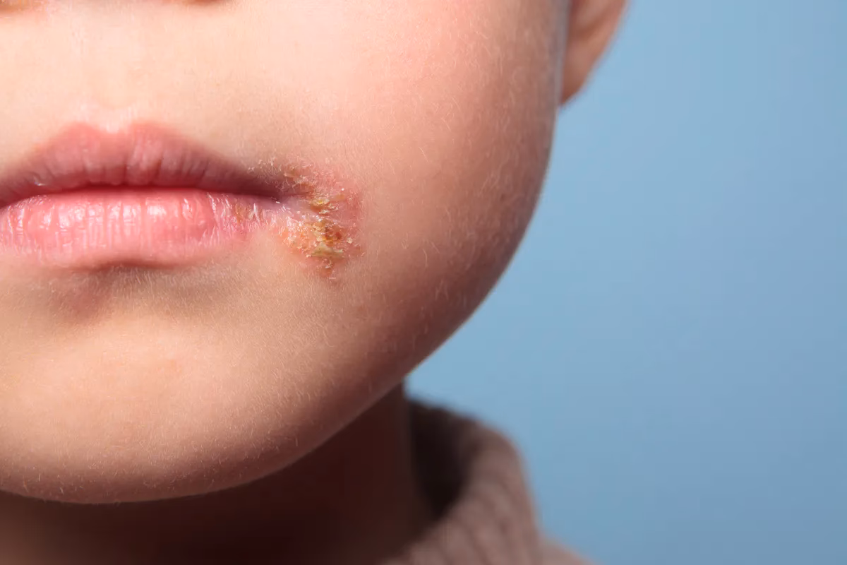 Quels sont les causes de l’herpès génital ?