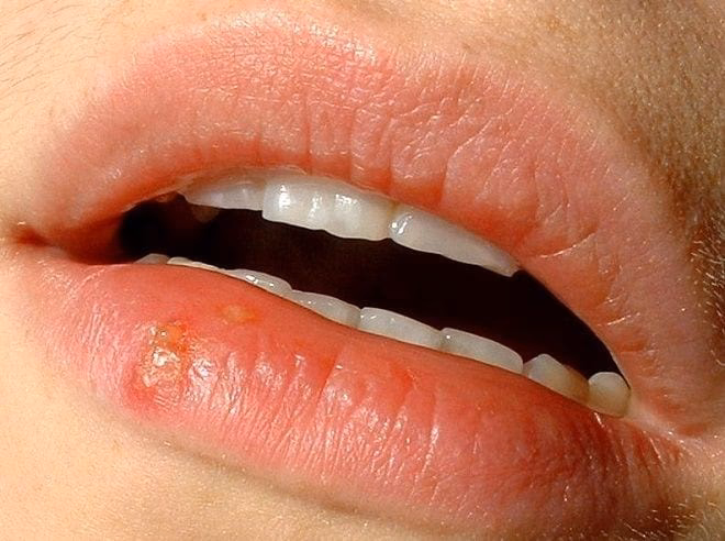 Quais são as espécies de herpes viridae mais disseminadas entre os seres humanos?