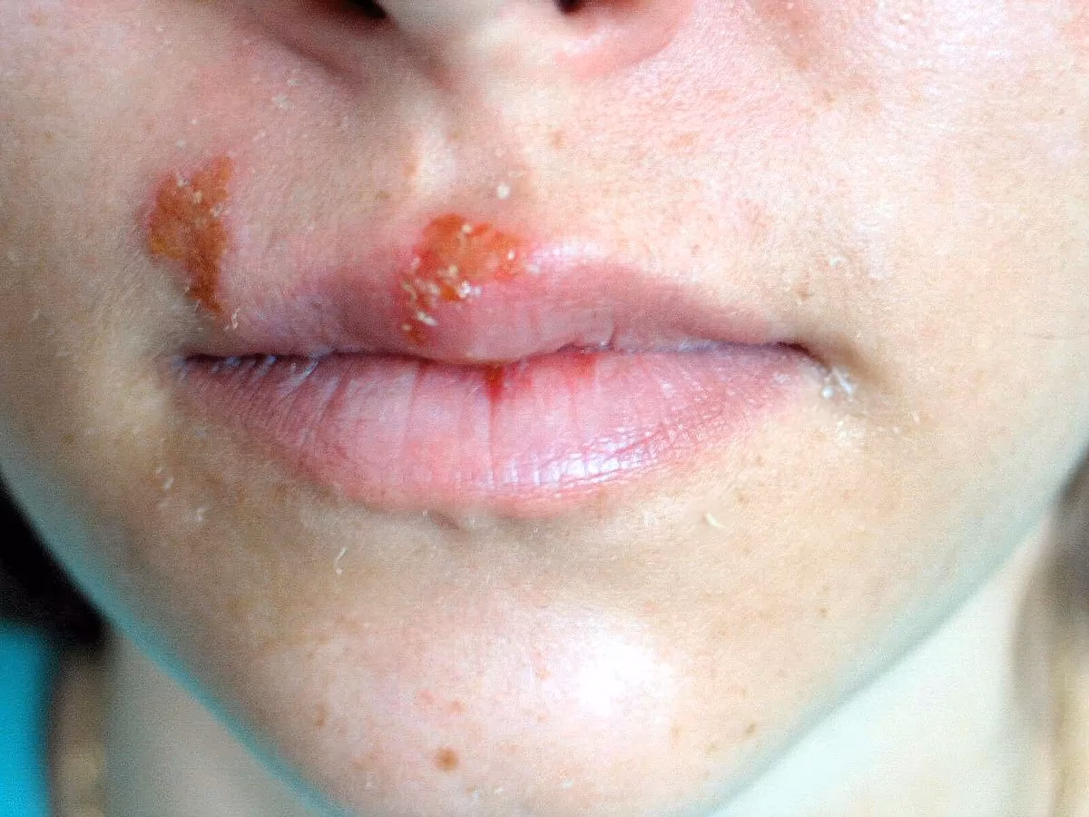 É possível morrer de herpes?
