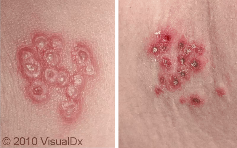 Por que o herpes pode ir embora e nunca mais voltar?