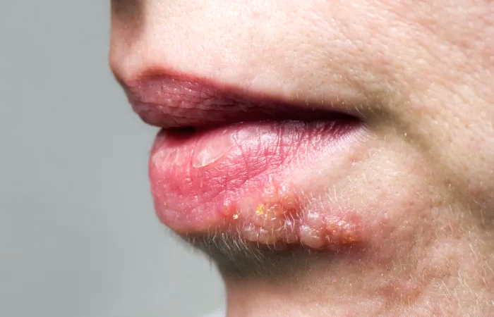 Como é a vida com herpes?
