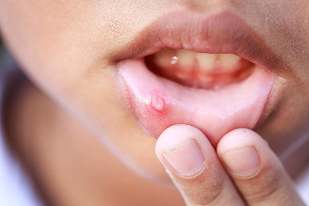 ¿Cuáles son los síntomas del herpes labial?