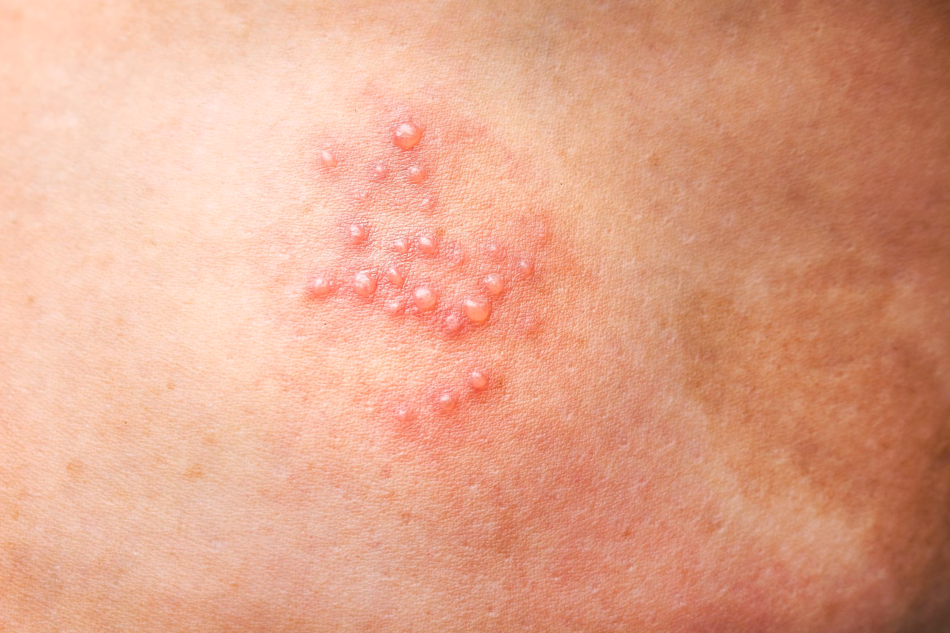 Onde as lesões da herpes são mais frequentes?