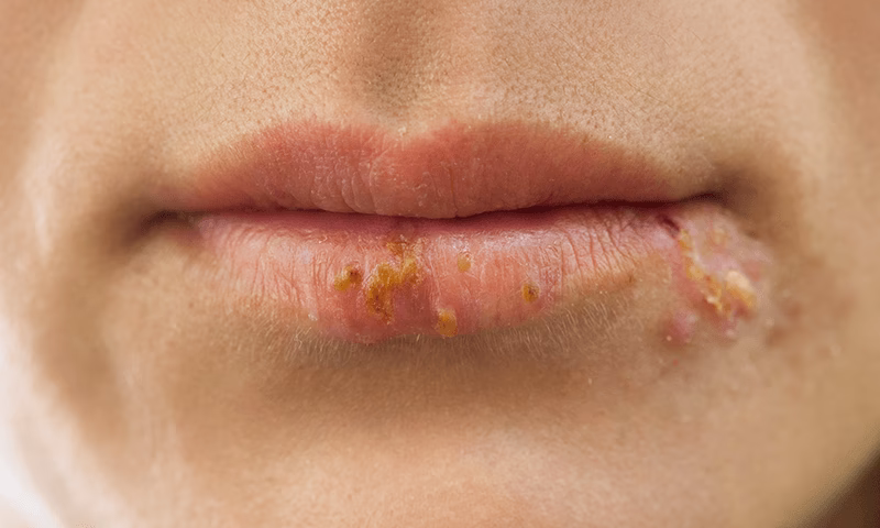 Wie macht sich Herpes bemerkbar?