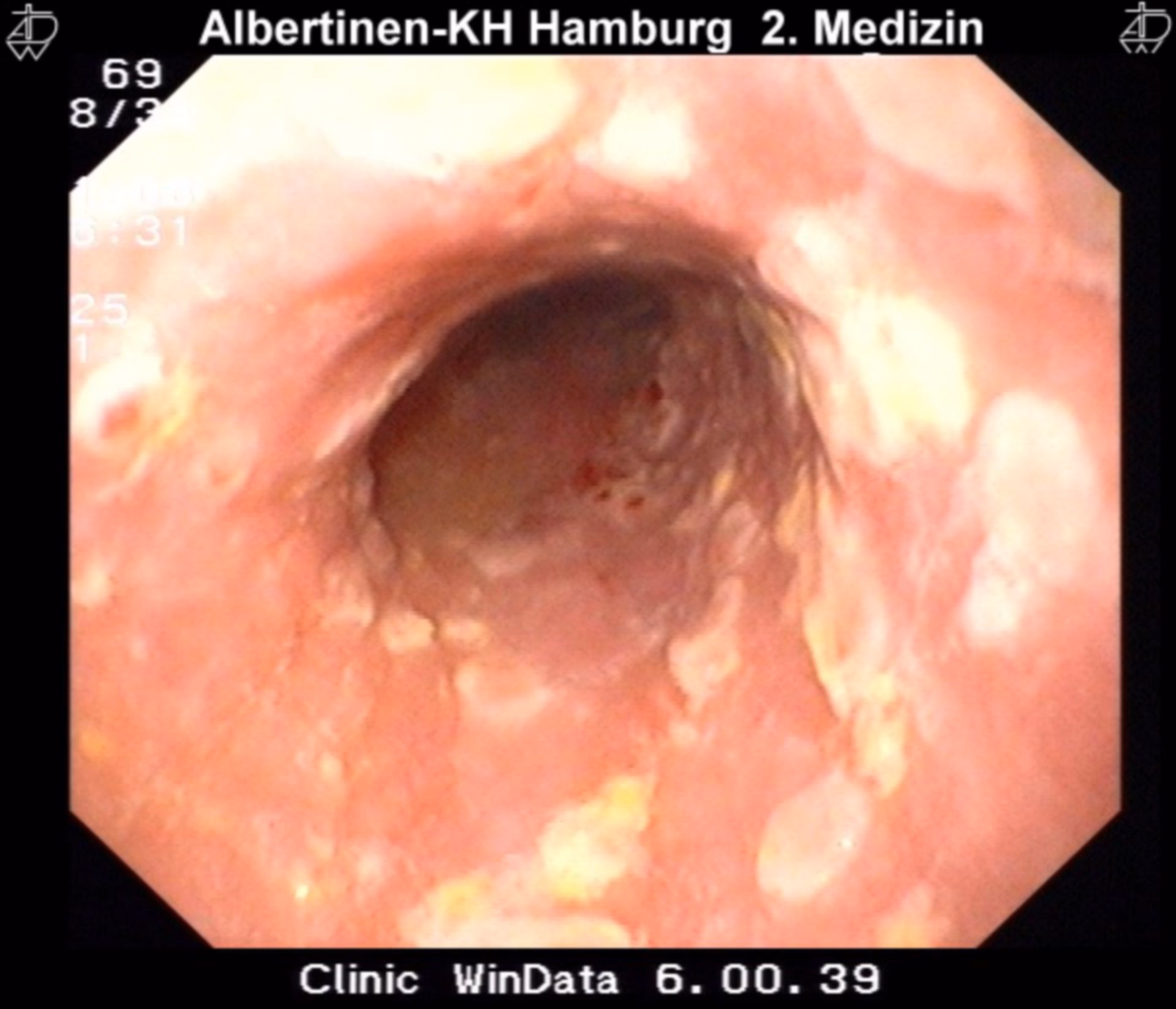 What is herpes esophagitis?