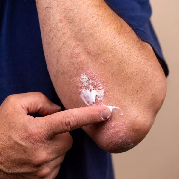 Can HSV cause a scrotum rash?