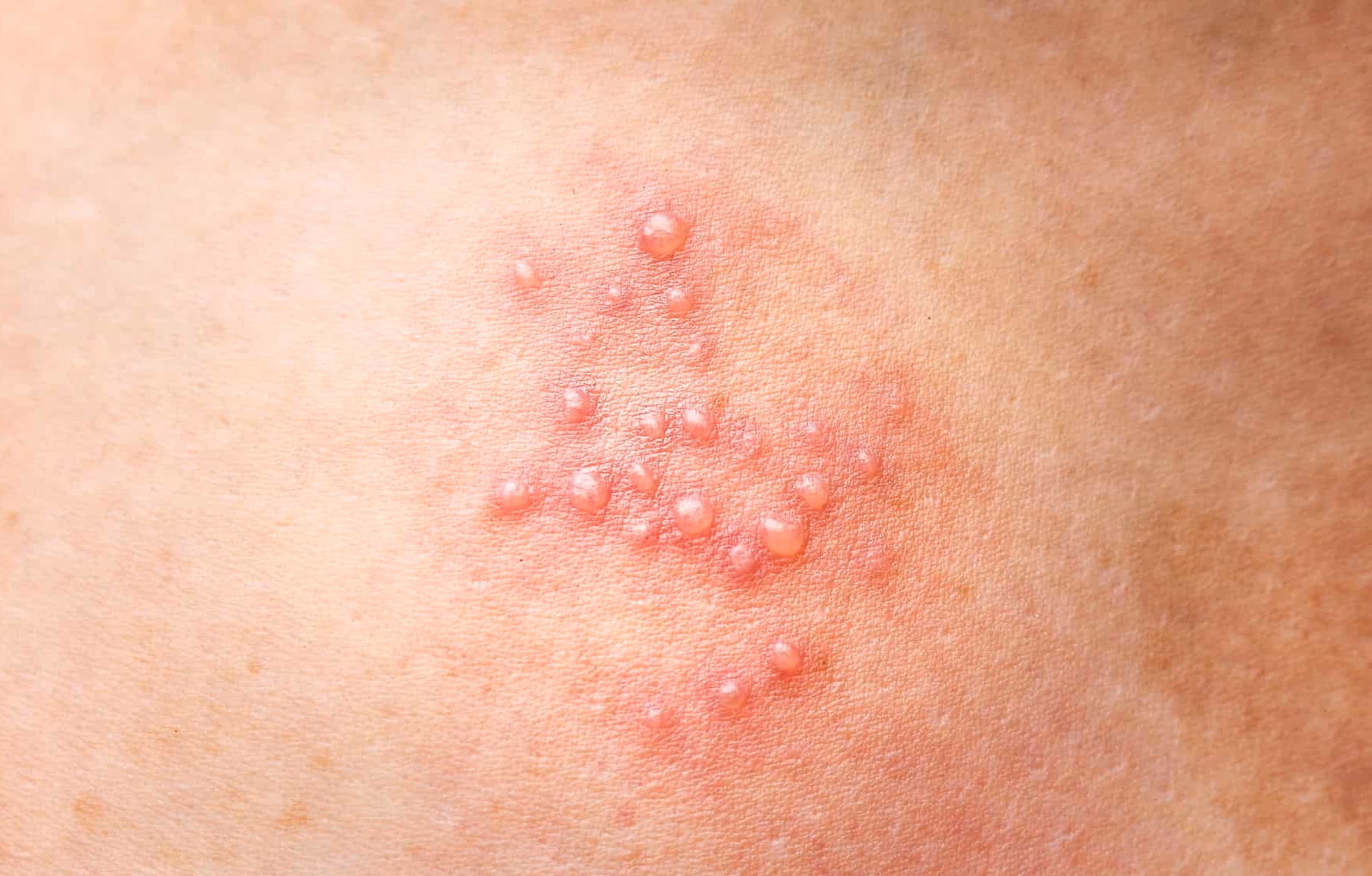 Are pimples a sign of herpes?