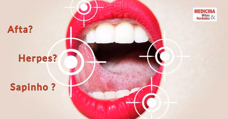 Quais são os sintomas da afta?