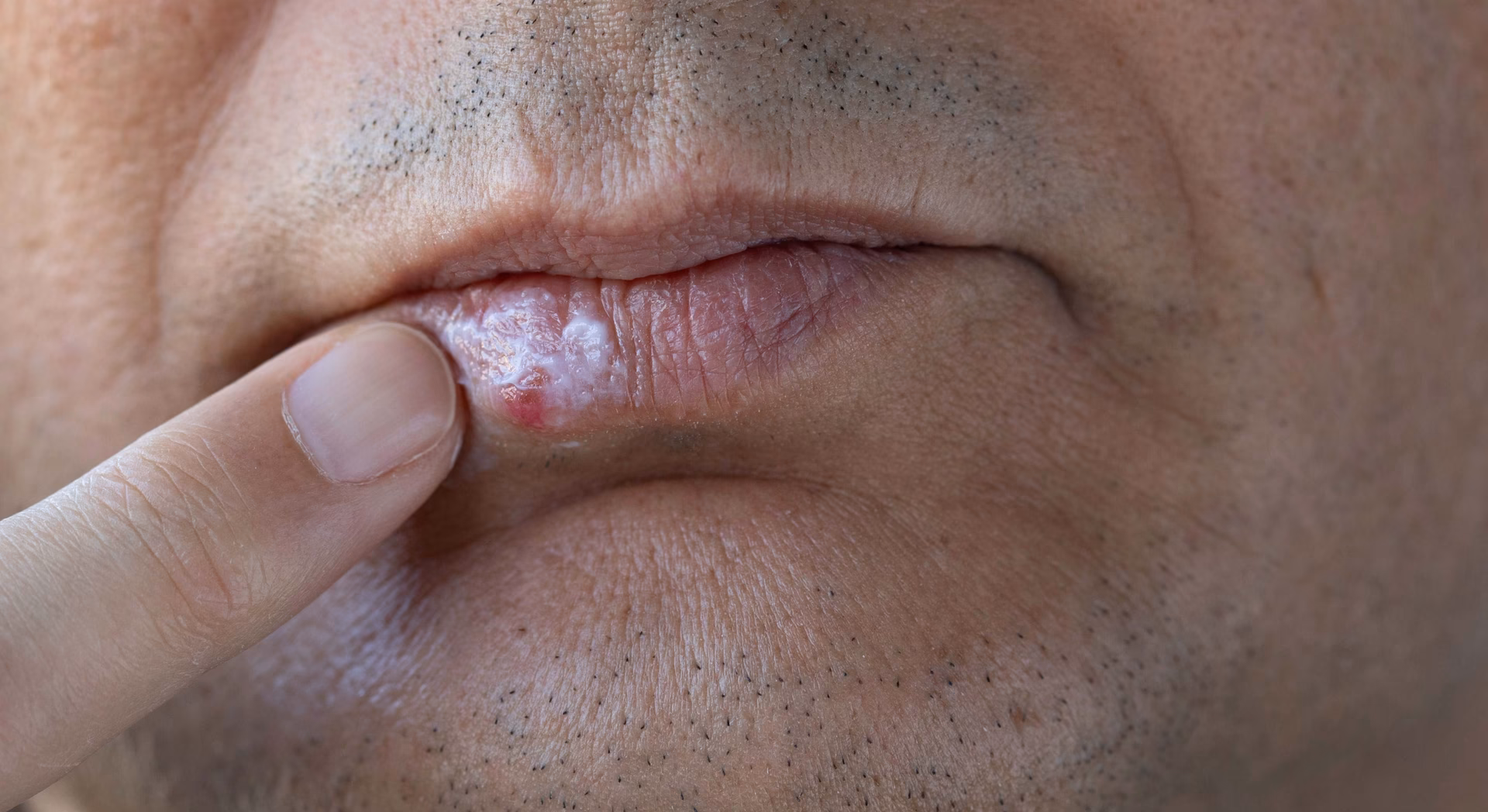 ¿Qué tan peligroso es el herpes?