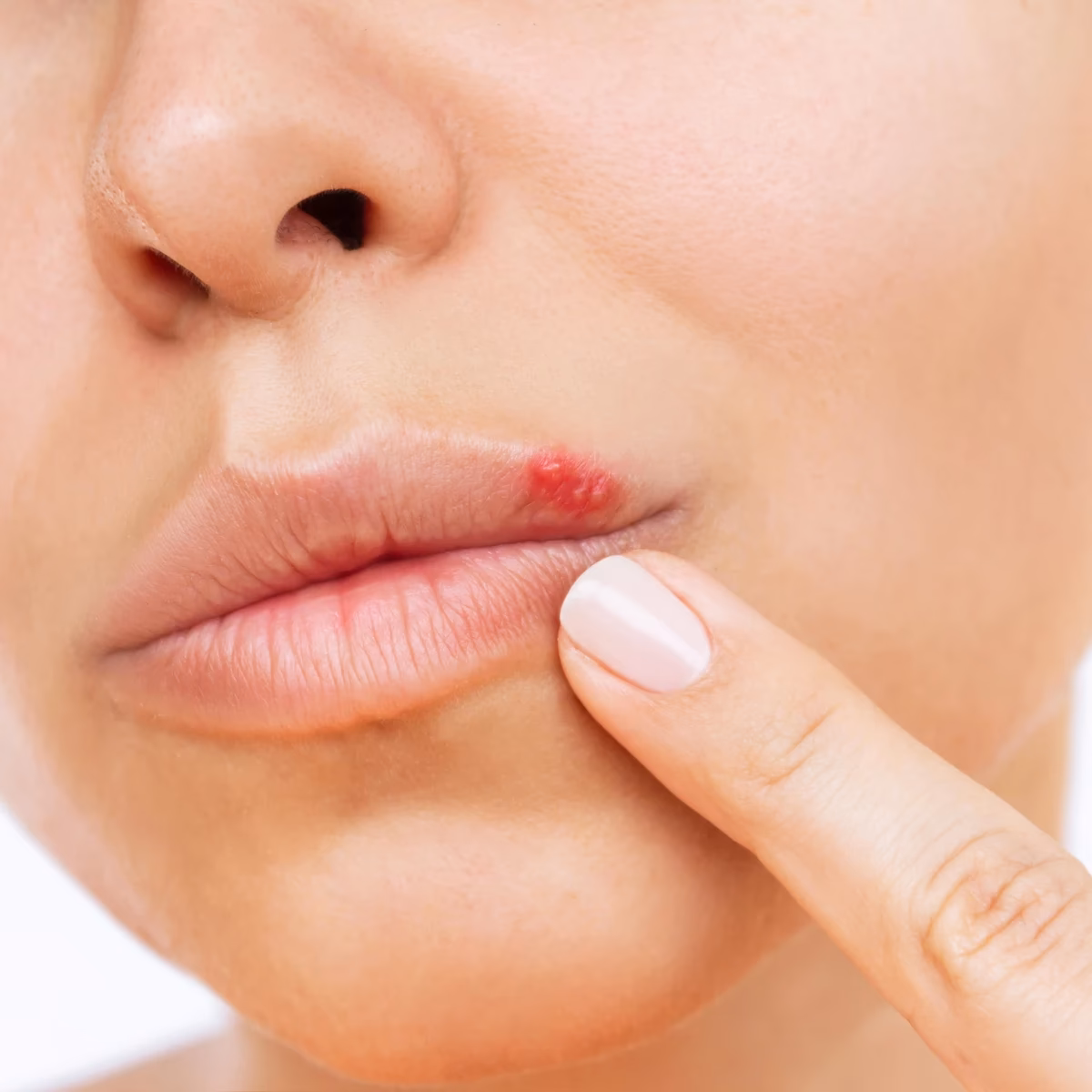 ¿Cuándo se contrae el herpes simplex?