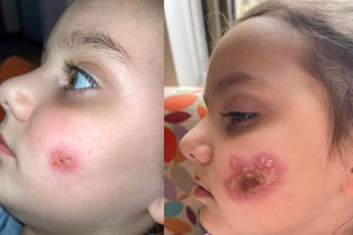 Como é feito o tratamento para a herpes?